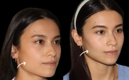 How Sculptra Fillers Treatment in Dubai Helps Beat Winter Skin