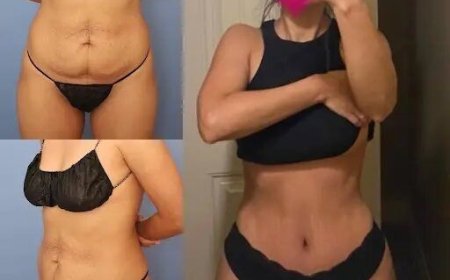 The Path to a Perfect Abdomen: Best Tummy Tuck Surgeons in Dubai