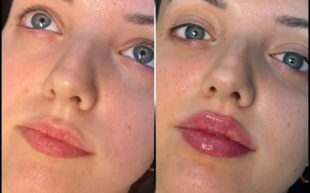 Everything You Should Know About the Fillers Treatment in Dubai