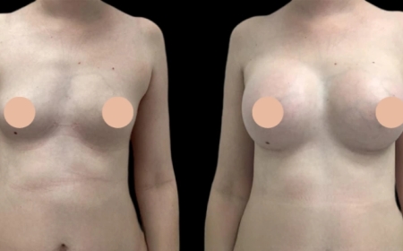 Discover Advanced Breast Augmentation Surgery in Dubai