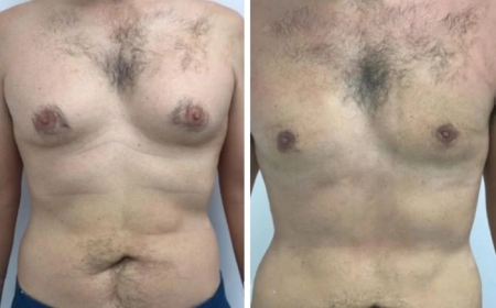 How Gynecomastia in Dubai is Treated: A Comprehensive Guide
