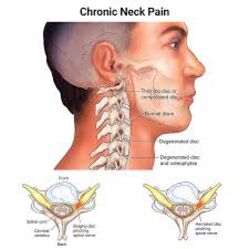 Chronic Nerve Pain in Neck: Long-Term Relief Options
