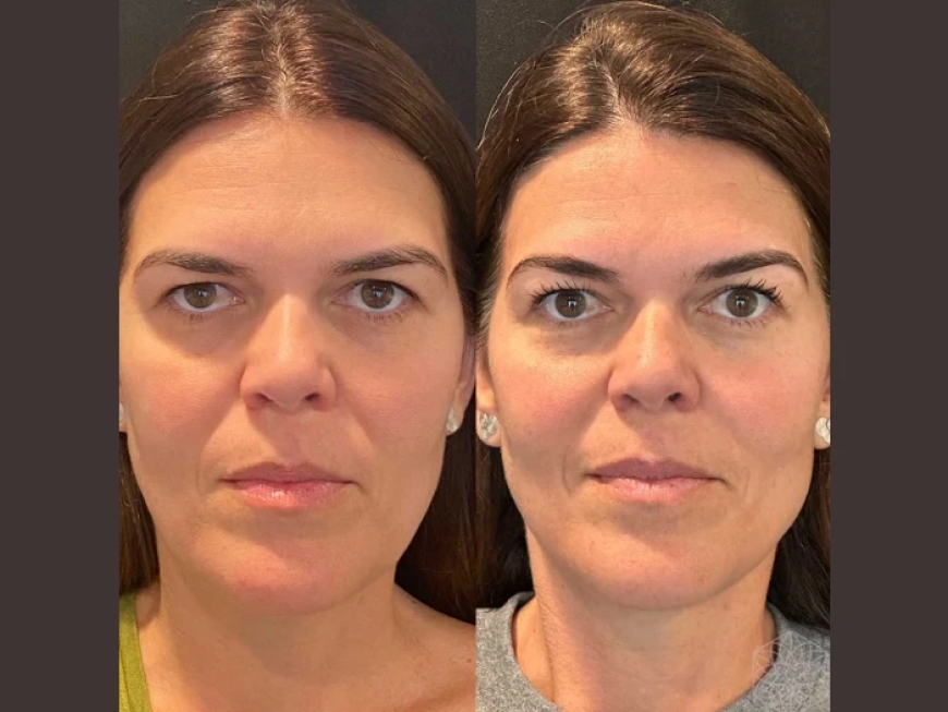 Thread Lift Treatment in Dubai: What Are the Different Types of Threads Used?