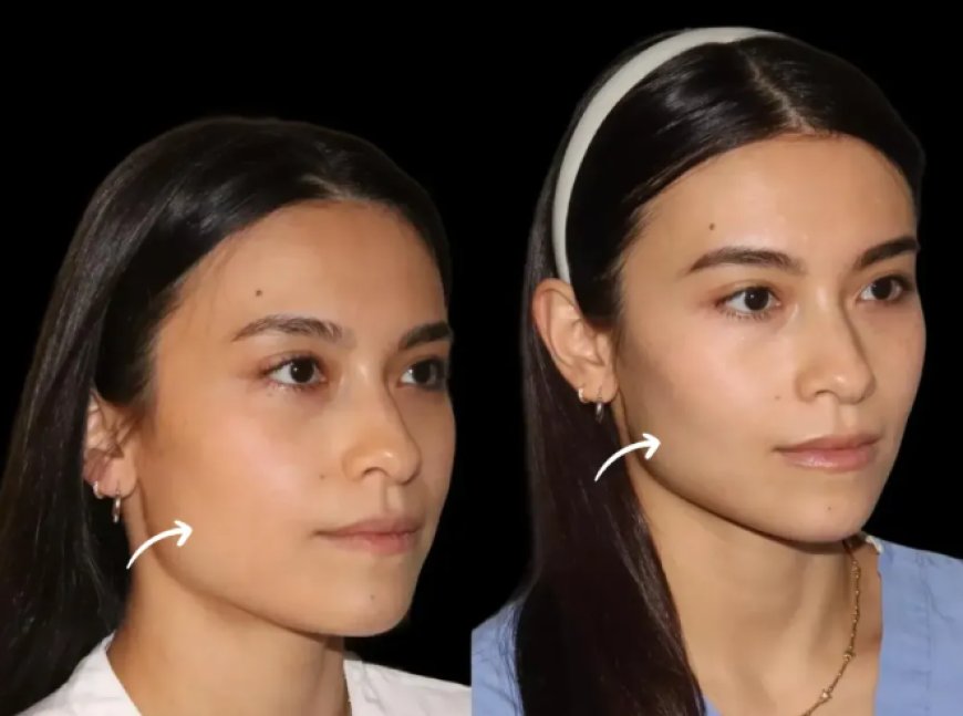 How Sculptra Fillers Treatment in Dubai Helps Beat Winter Skin