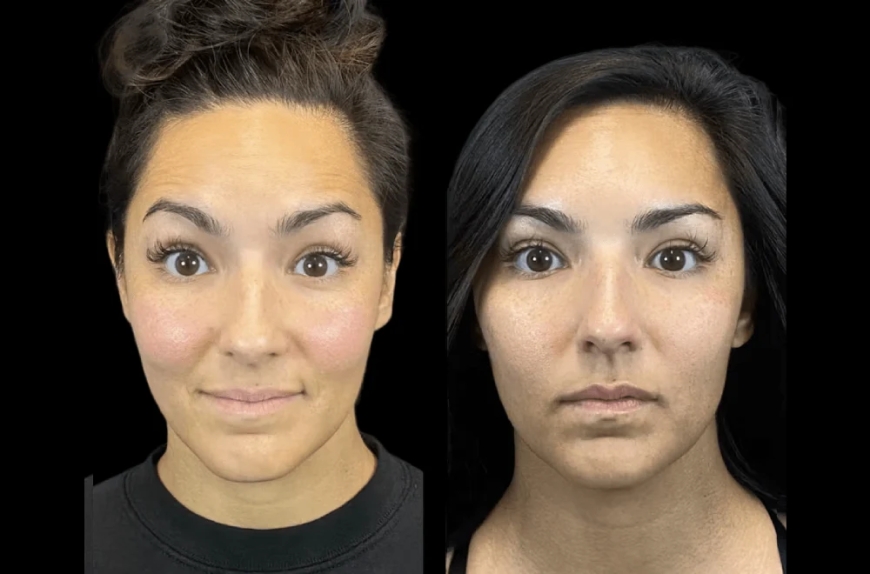 Why More Men Are Opting for Botox Treatment in Dubai