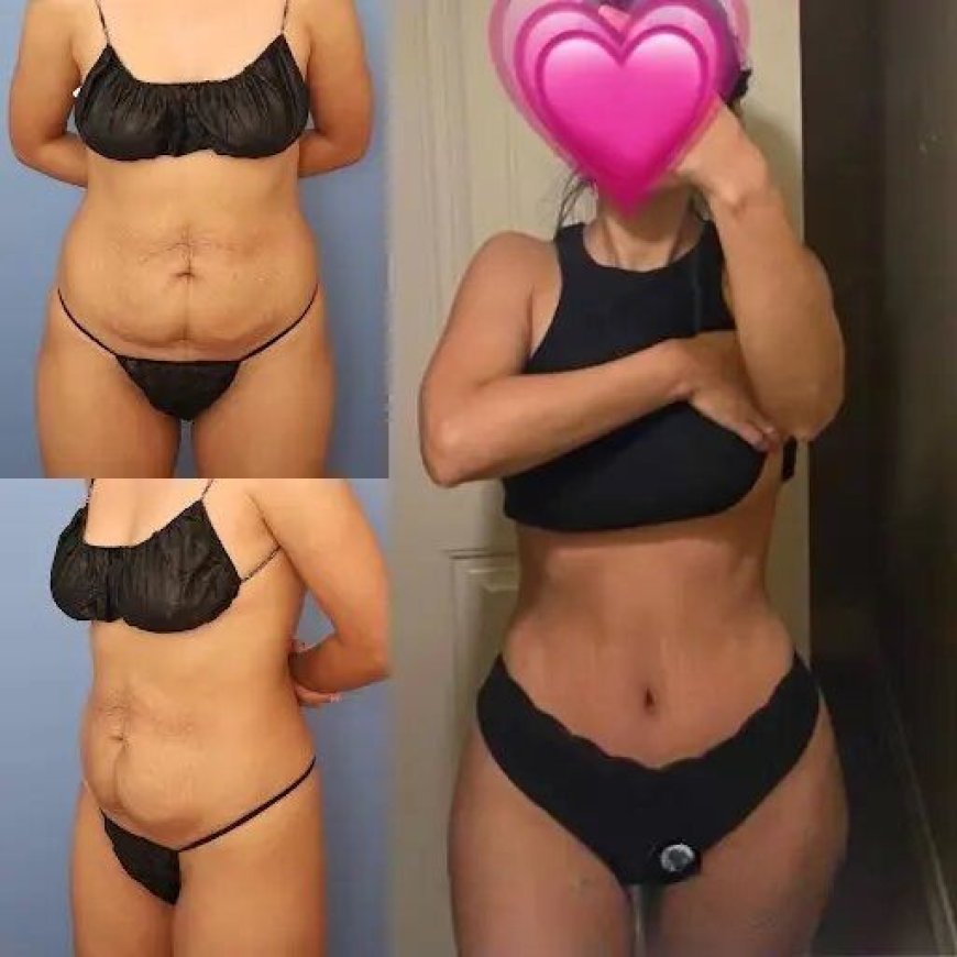The Path to a Perfect Abdomen: Best Tummy Tuck Surgeons in Dubai
