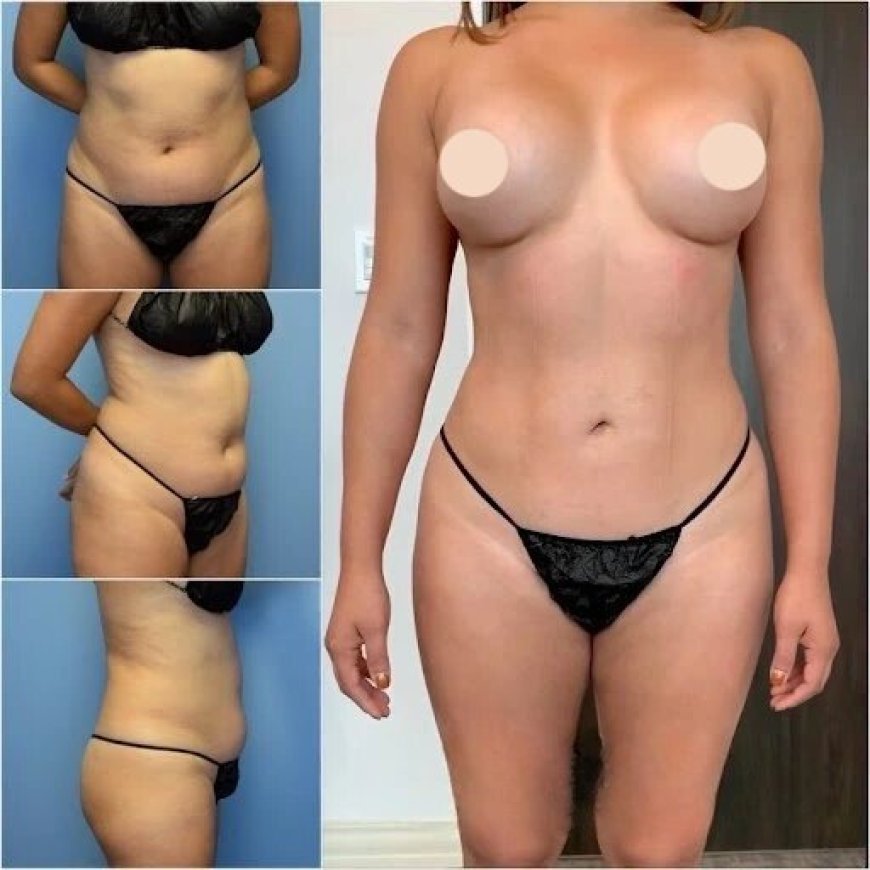 The Best Body Contouring Surgeons in Dubai: Achieving Realistic, Beautiful Results