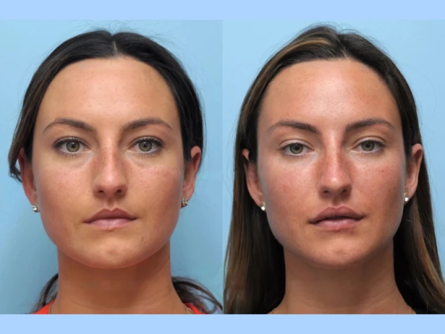 Thread Lift Treatment in Dubai: A Non-Surgical Skin Solution