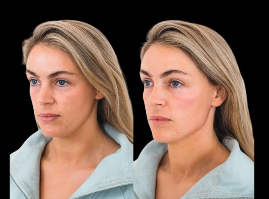 How the Best Doctors in Dubai Adjust Cheek Fillers Treatments Over Time