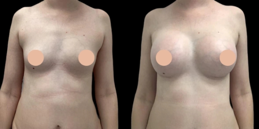 What Recovery Looks Like After Breast Augmentation in Dubai