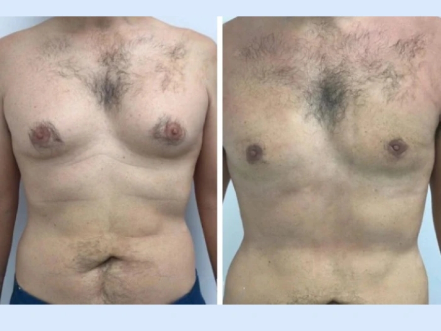 How Gynecomastia in Dubai is Treated: A Comprehensive Guide
