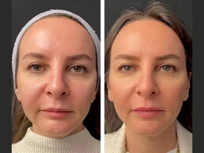 Best Doctors in Dubai for Anti-Aging Mesotherapy: Who to Trust