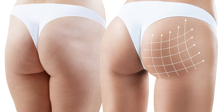Why Butt Fat Transfer in Dubai Is Becoming the Go-To Procedure for Body Contouring