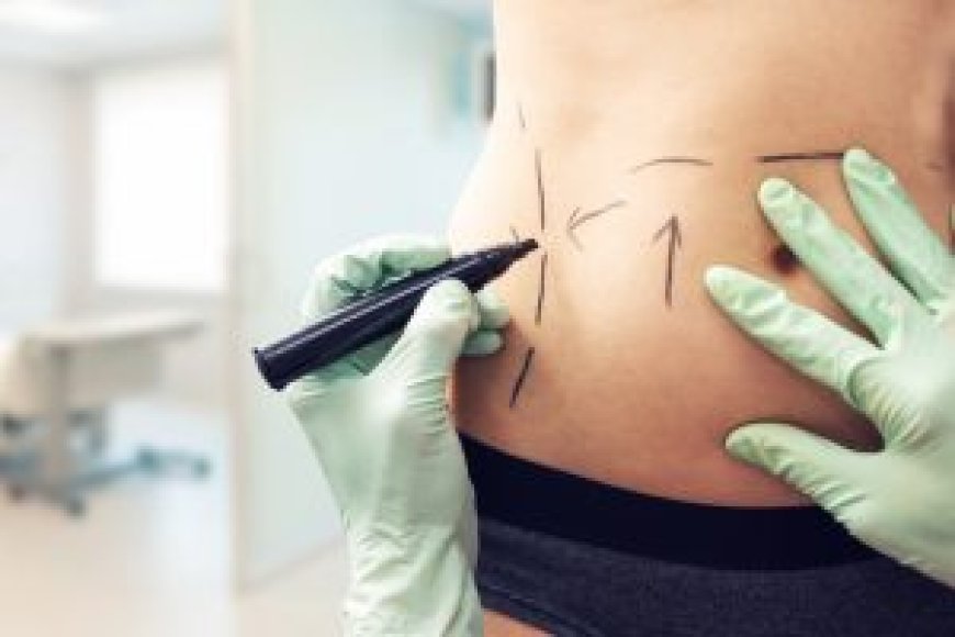 Abdominoplasty Dubai: How Long Do Results Really Last?