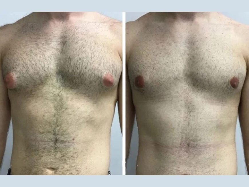Health Insurance and Gynecomastia in Dubai