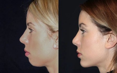 Chin Fillers in Dubai: Sculpt Your Chin with the Best Experts