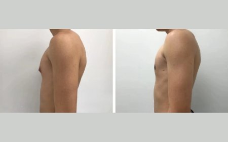 Living With Gynecomastia in Dubai’s Fitness Culture