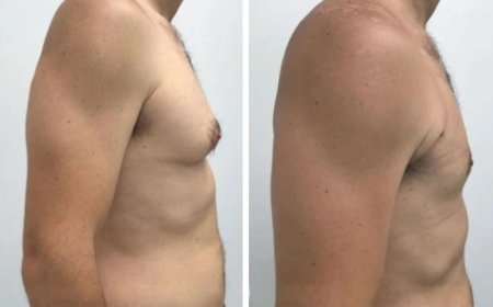 How to Choose the Best Doctors in Dubai for Your Gynecomastia Treatment