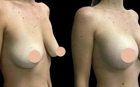 Breast Augmentation in Dubai: What Makes It a Global Cosmetic Hub