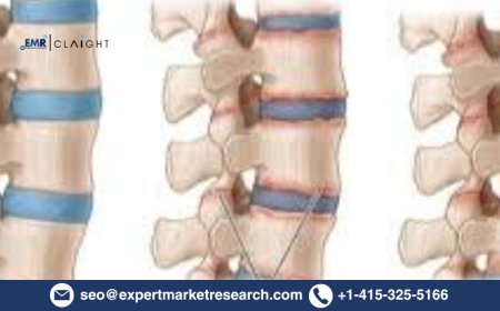 Ankylosing Spondylitis Treatment Market Size & Share 2034