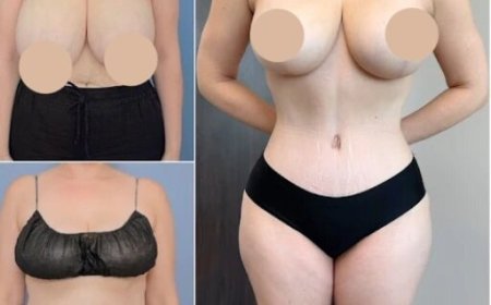 Choosing the Best Tummy Tuck Surgeon in Dubai for Your Body Goals