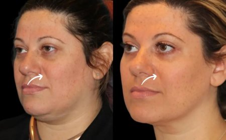 How the Best Doctors in Dubai Shaped Sculptra Fillers’ Local Adoption