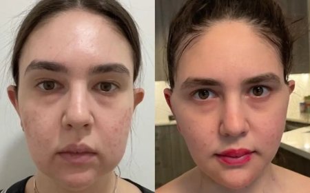 Buccal Fat Removal in Dubai for a More Youthful Look