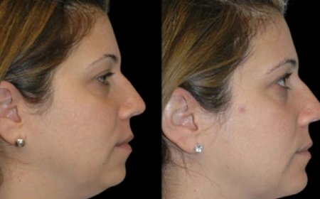 Best Double chin removal Surgeons in Dubai Talk About Ethnic Facial Anatomy