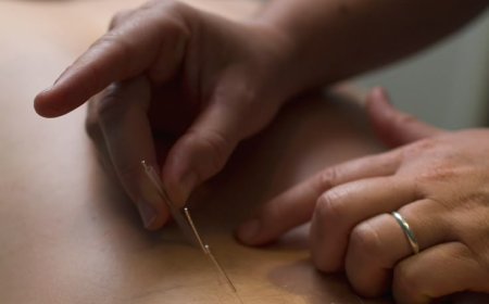 Acupuncture for Menopause Relief: A Natural Remedy for Hormonal Balance