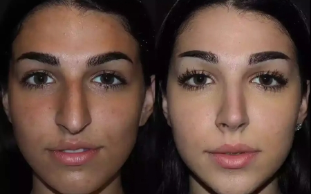 Expert Tips from the Best Rhinoplasty Surgeon in Dubai