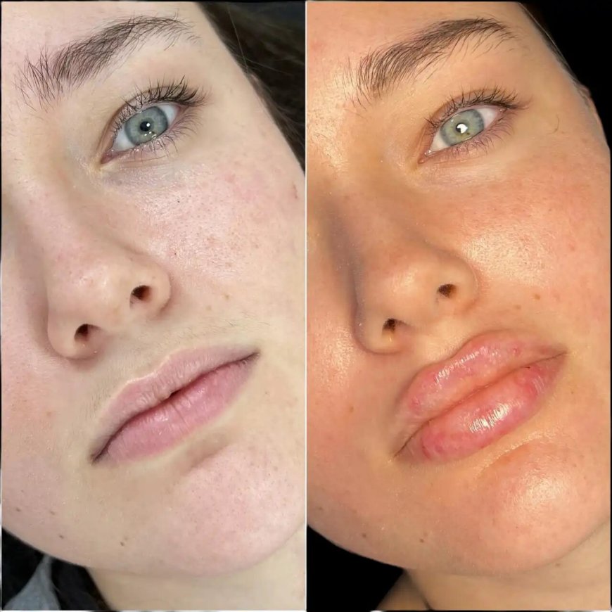 Fillers in Dubai: A Beginner’s Guide to Facial Fillers