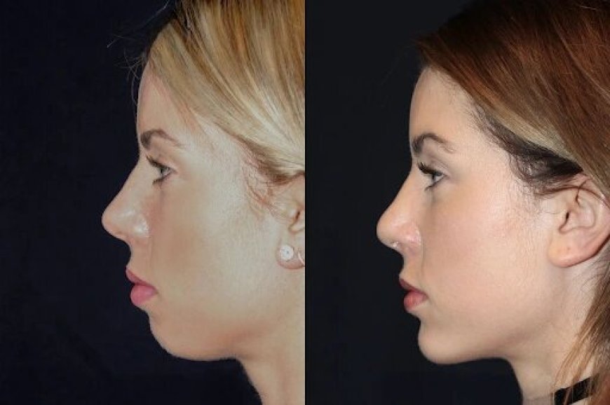 Chin Fillers in Dubai: Sculpt Your Chin with the Best Experts