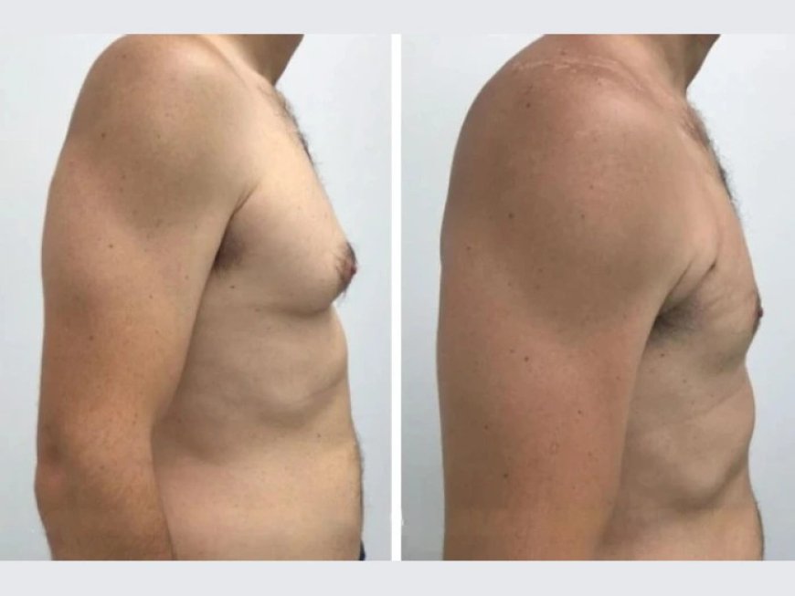 How to Choose the Best Doctors in Dubai for Your Gynecomastia Treatment