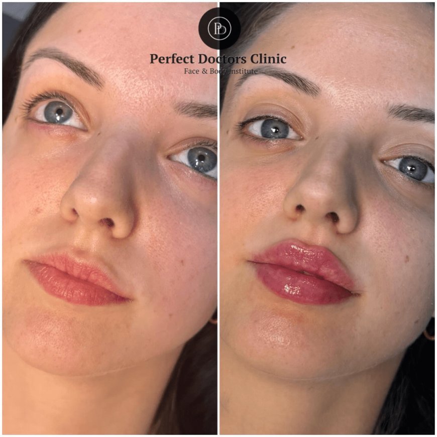 How to Prepare for Your Juvederm Appointment: Expert Advice from the Best Plastic Surgeon in Dubai