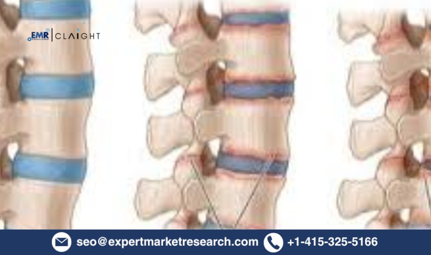 Ankylosing Spondylitis Treatment Market Size & Share 2034