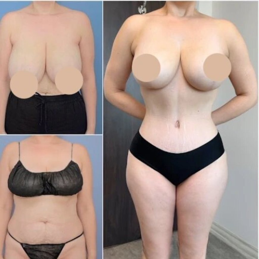 Choosing the Best Tummy Tuck Surgeon in Dubai for Your Body Goals