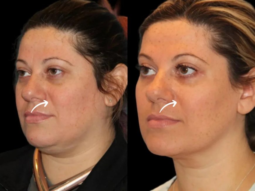 How the Best Doctors in Dubai Shaped Sculptra Fillers’ Local Adoption