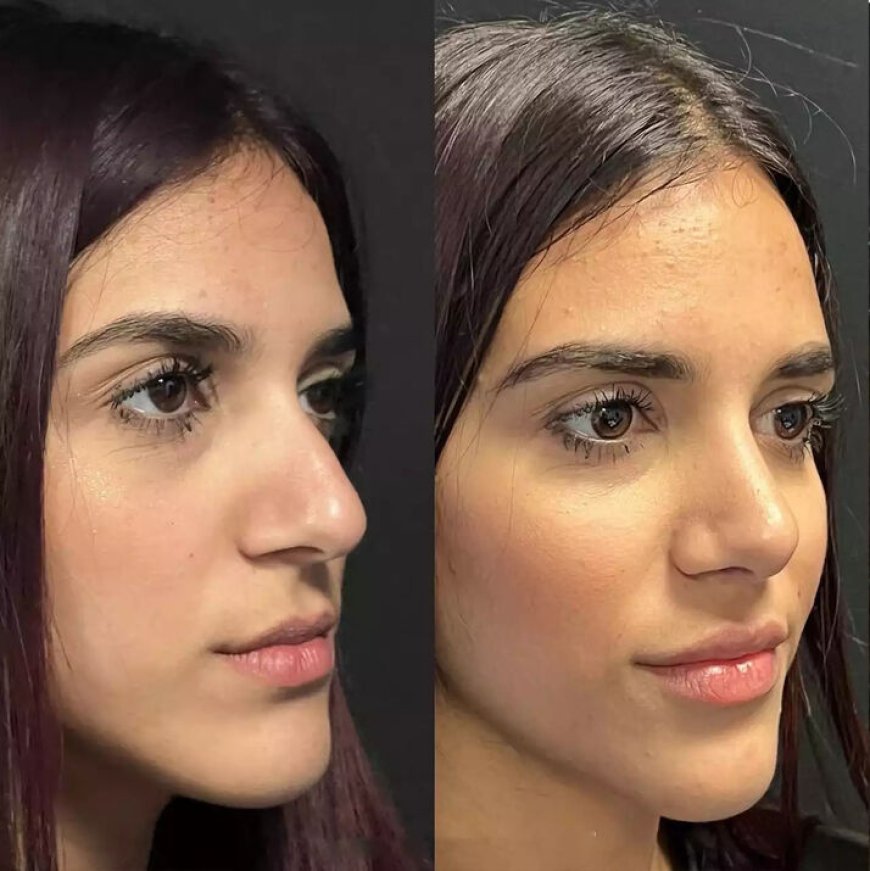 Why Septoplasty by Best Doctors in Dubai Works