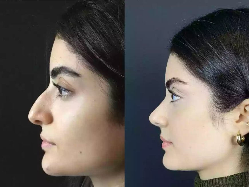 Best Doctors in Dubai for Facial Harmony and Rhinoplasty