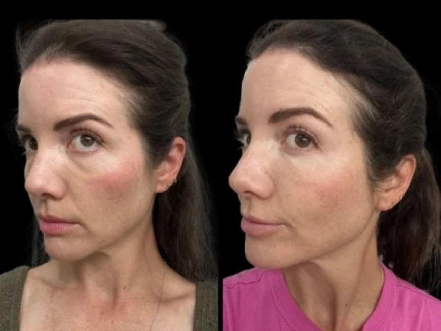 Best Aesthetic Clinic in Dubai: Expert Tips for Preventing Dark Circles treatment