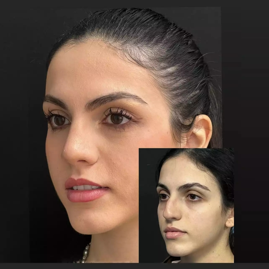 Affordable Rhinoplasty in Dubai: Cost Breakdown and Value
