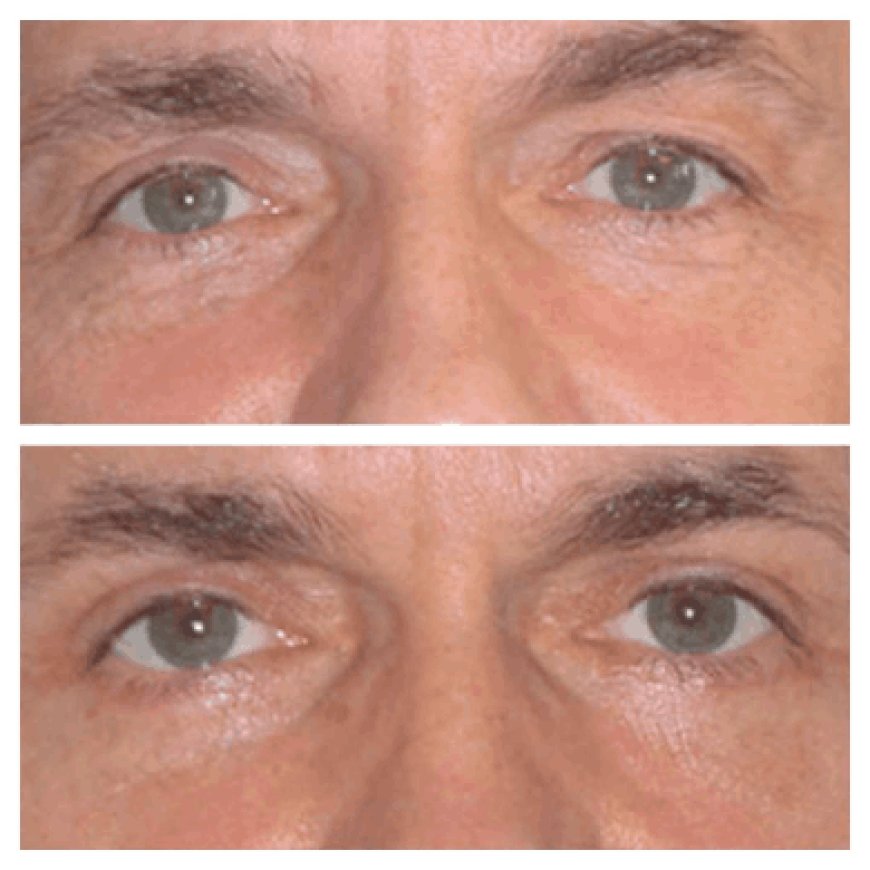 The cost breakdown of Eye bag removal in Dubai