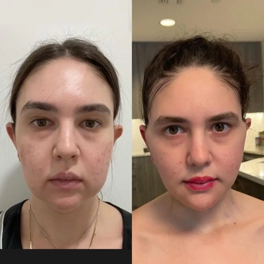 Buccal Fat Removal in Dubai for a More Youthful Look