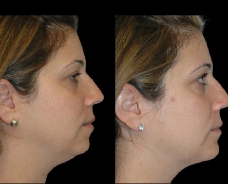 Safe and Effective DIY Tips vs Professional Double chin removal in Dubai